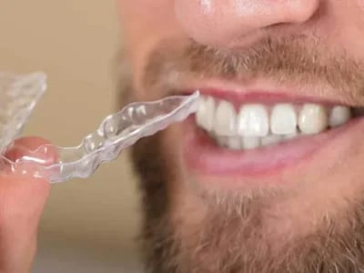 Zahnschienen: Der Weg zu einem perfekten Lächeln